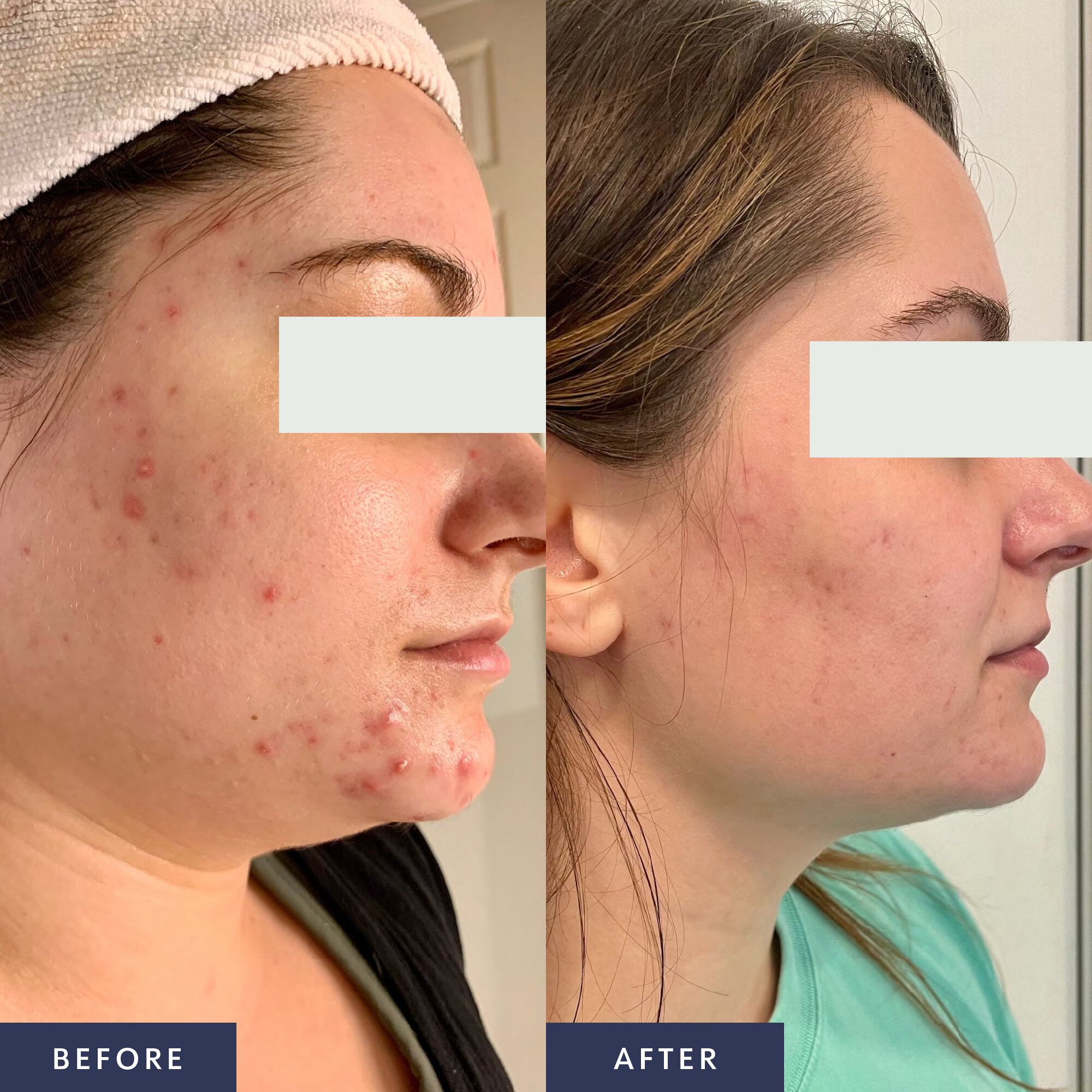 mikura-skincare-clear-skin-program-real-results-7.jpg