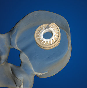 4. Once cured, the cement interlocks the Implant to the bone.