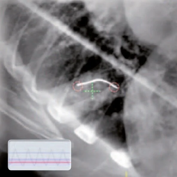 Visicoil Fiducial Marker — IZI Medical