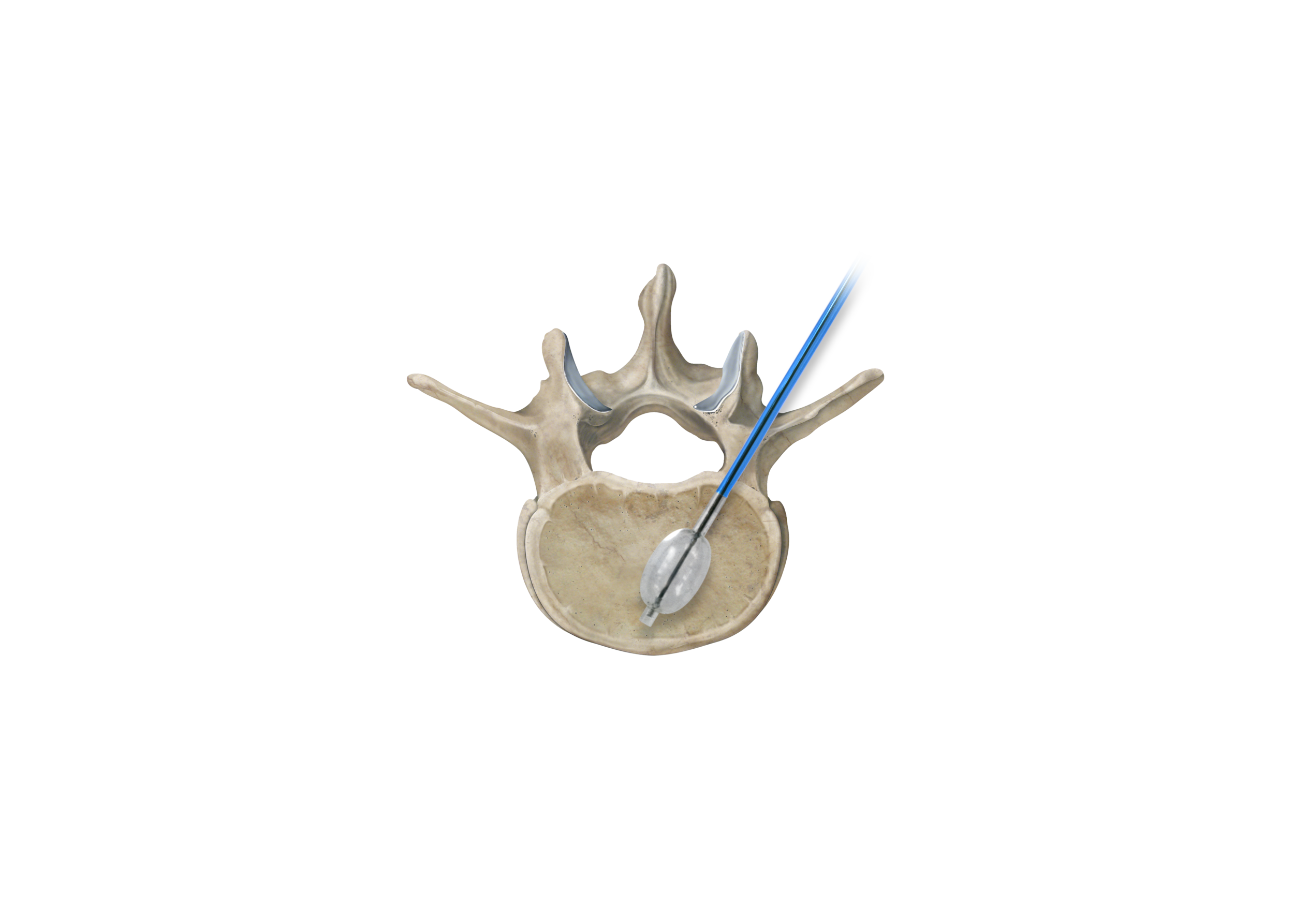 IZI Medical Products Announces the Launch of its Osteo-Site Vertebral Balloon and Its Complete VCF Treatment Toolbox