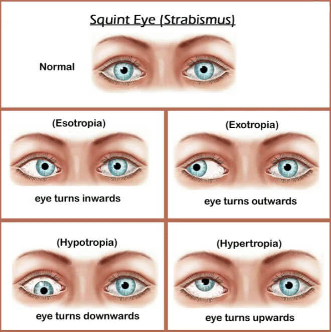 A Lifetime of Double Vision: A Case Report and Literature Review of Chronic Strabismus 