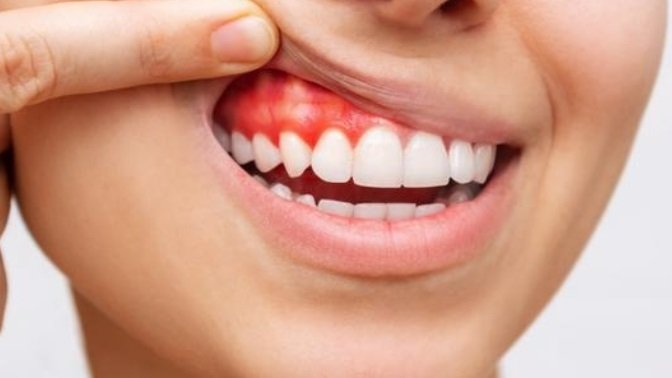 Gum Disease - Everything Your Dentist Needs You to Know