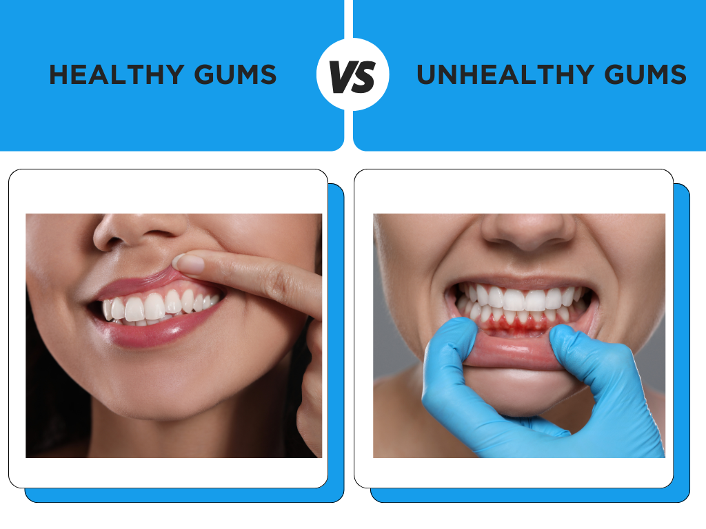 Unhealthy Teeth And Gums unhealthy-teeth-and-gums