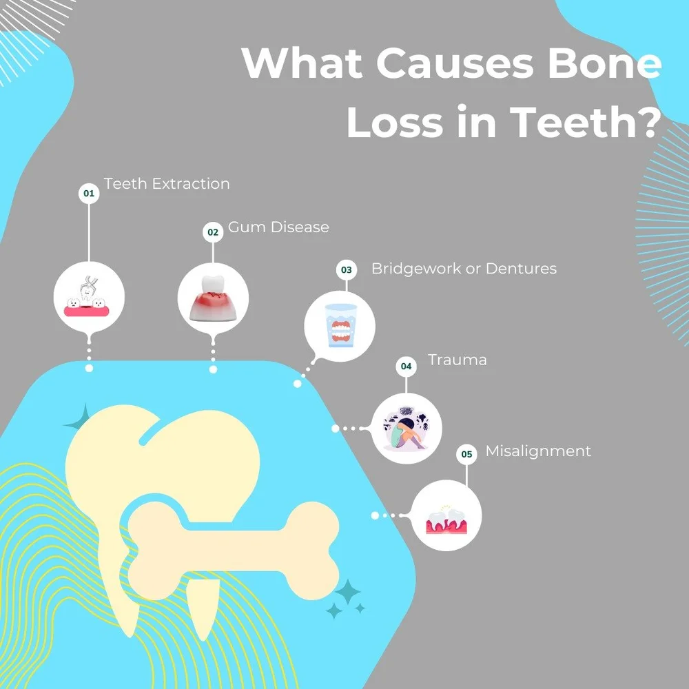 Bone Loss in Teeth 5 Common Causes & Treatments KWC Dental