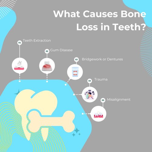 Bone Loss in Teeth 5 Common Causes & Treatments KWC Dental