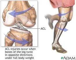 ACL Injure