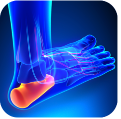 Heel Spur