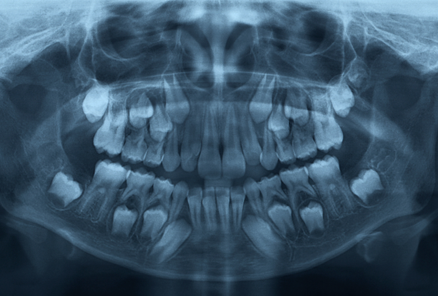 Why Does The Dentist Take X-Rays Of My Teeth?