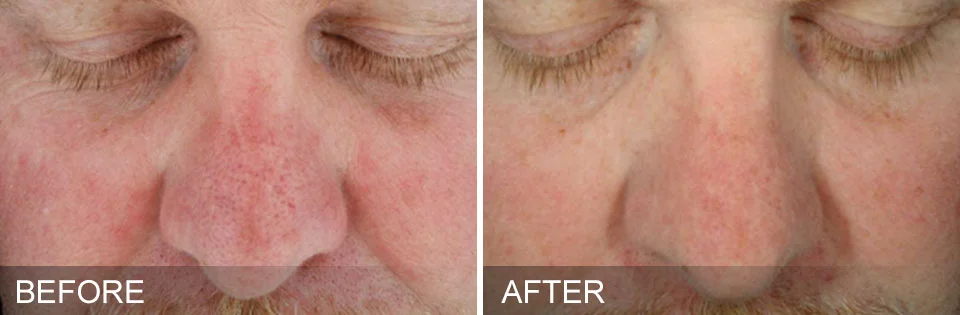before-after-SunDamage.jpg