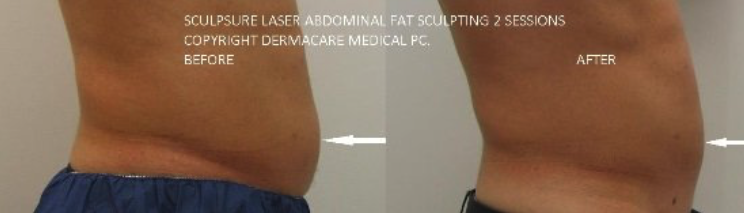 adl-nyc-sculpsure-091.png