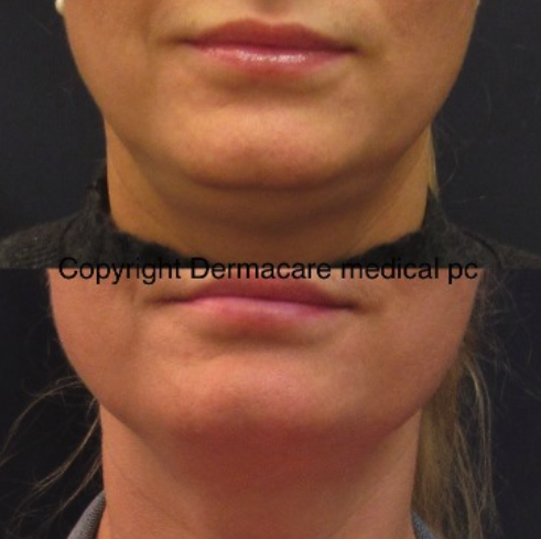 adl-nyc-sculpsure-093.png