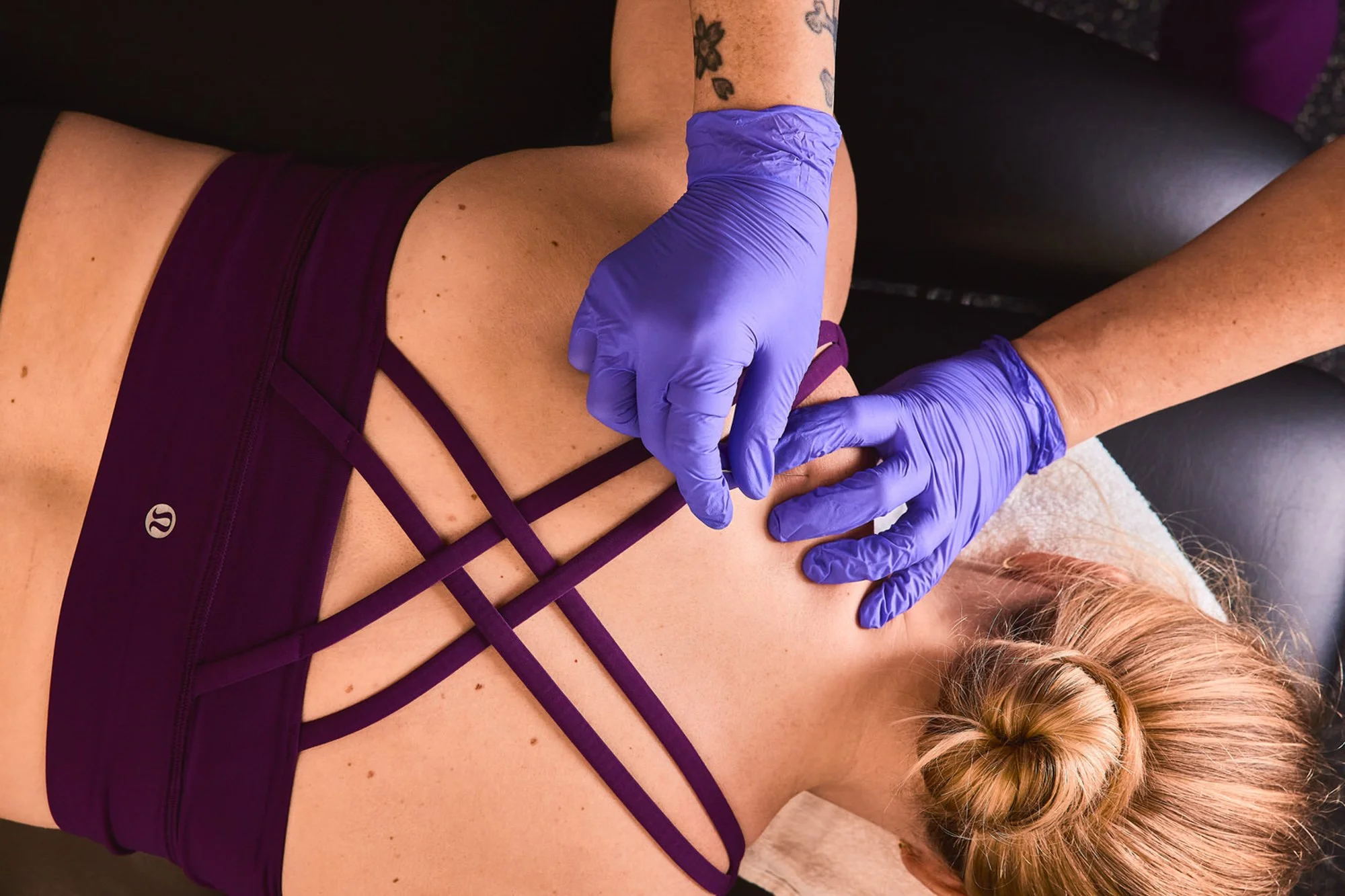 Dry Needling Jacksonville Beach