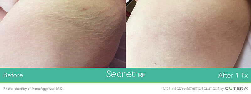 Secret-RF-Before-and-After-7.jpg