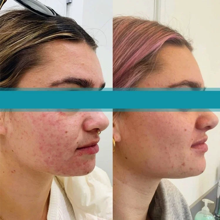 eczema2+S+Dennis.jpg