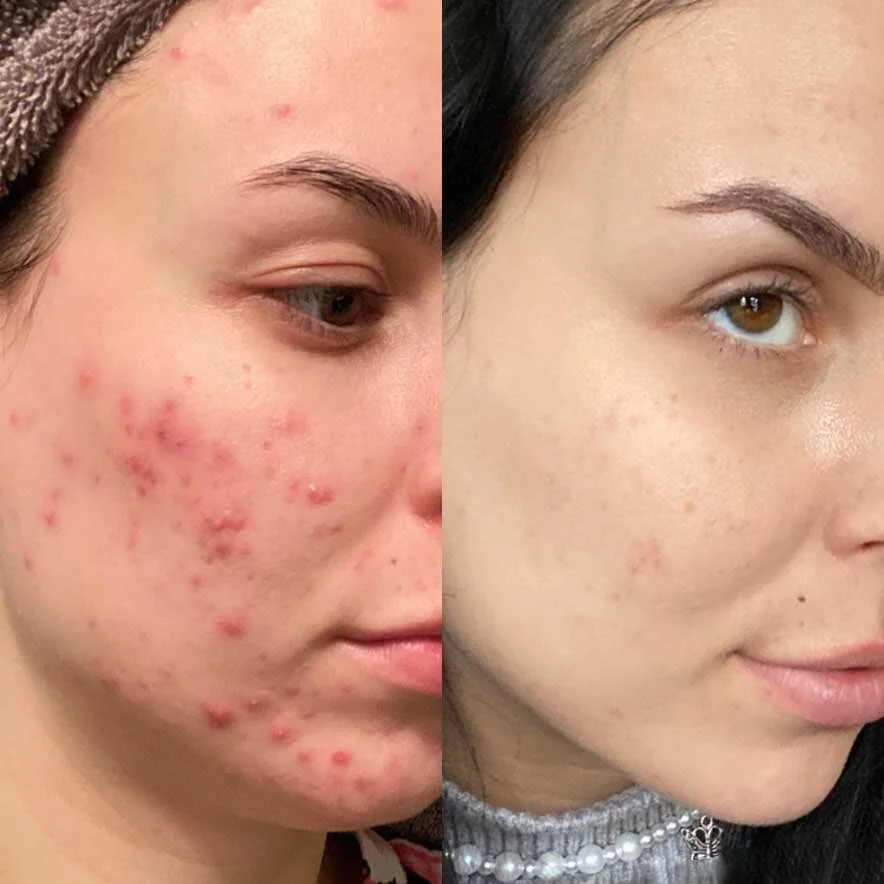 Acne Gallery — Nu Image Medical Esthetics