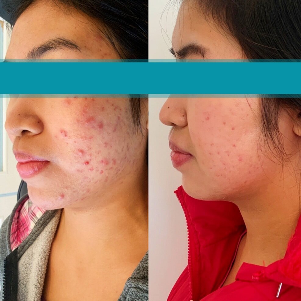 Significant improvement in facial acne