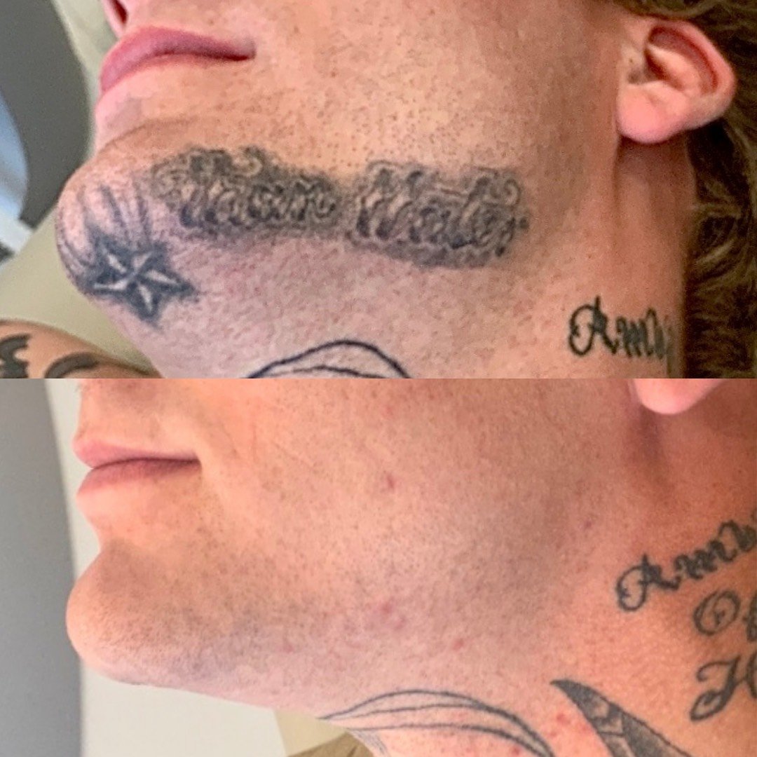 Tattoo Removal Gallery — Nu Image Medical Esthetics