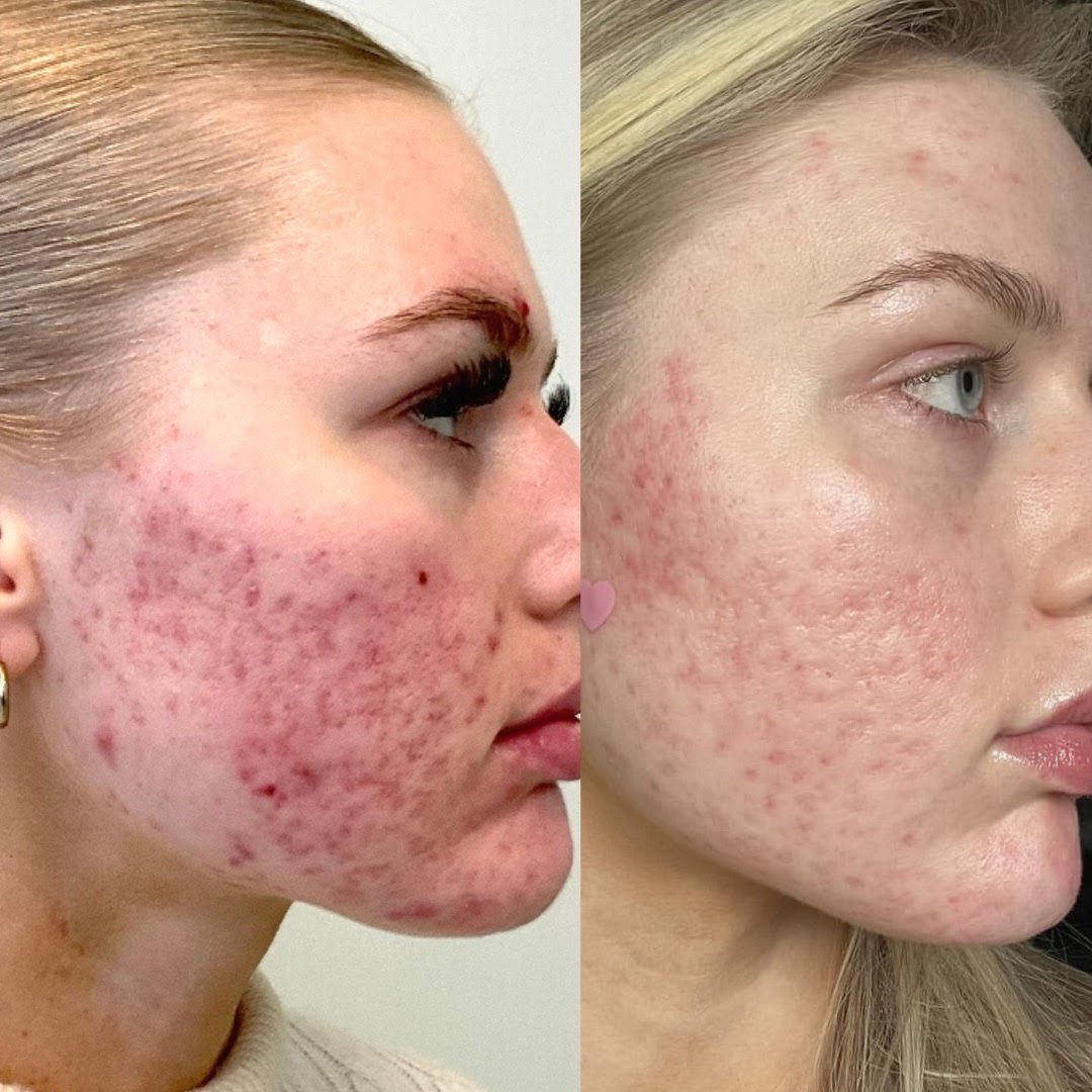 Remarkable improvement in redness with laser and chemical peel treatments.