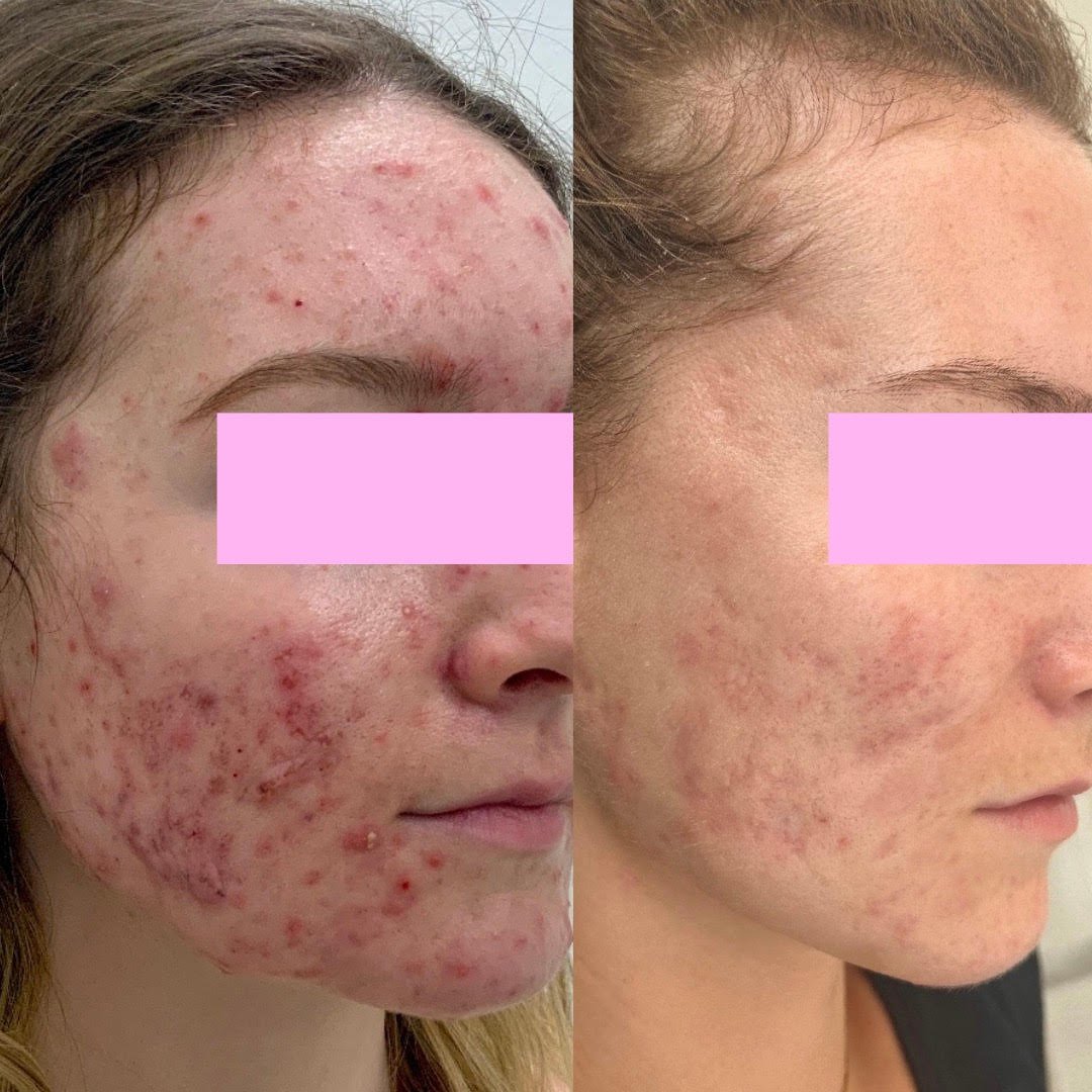 Real improvement in the battle against acne!