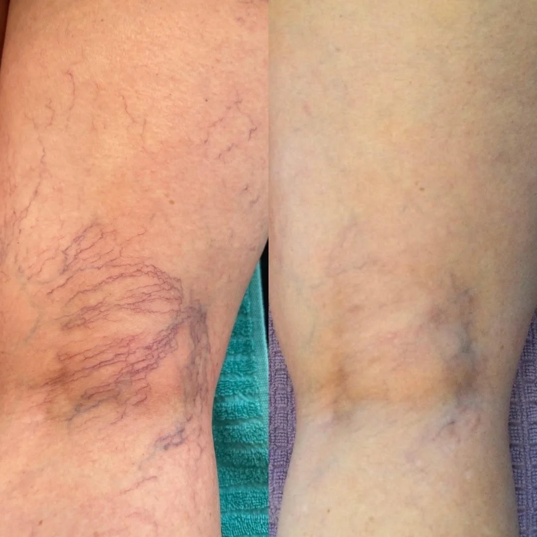 Fotona Spider Vein Treatment — Nu Image Medical Esthetics