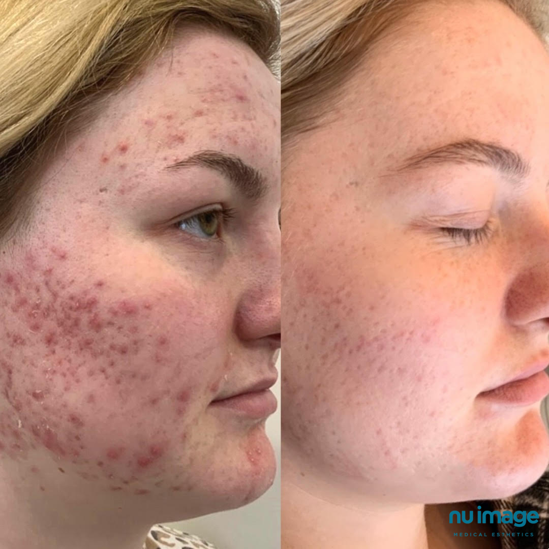  This remarkable result was achieved with  a combination therapy of Fotona laser, chemical peels, Microneedling and IPL. She also used medical grade skincare along the way.  The before photo is from March 1st 2021, and the after photo is from yesterd