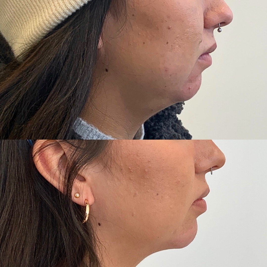 Nice improvement in chin appearance!