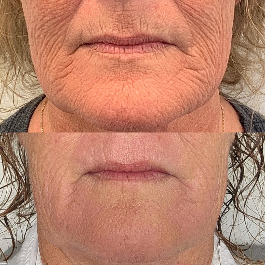 Plexr results achievers after only 1 treatment, by our talented Senior Medical Esthetican &amp; Laser Technician, Vida Chapple 😍 

Looking for a non-surgical option for wrinkles? Stubborn fine lines on the face? Eyelid? Under eye? Look no further 🙌