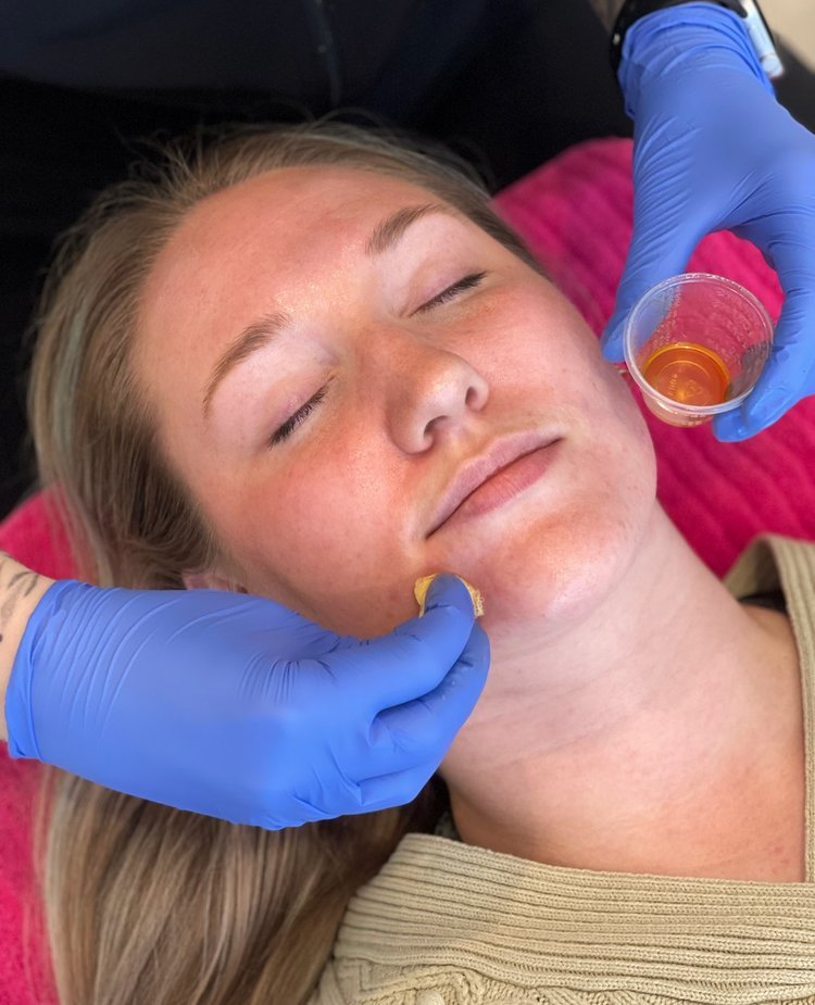 chemical_peel.jpeg