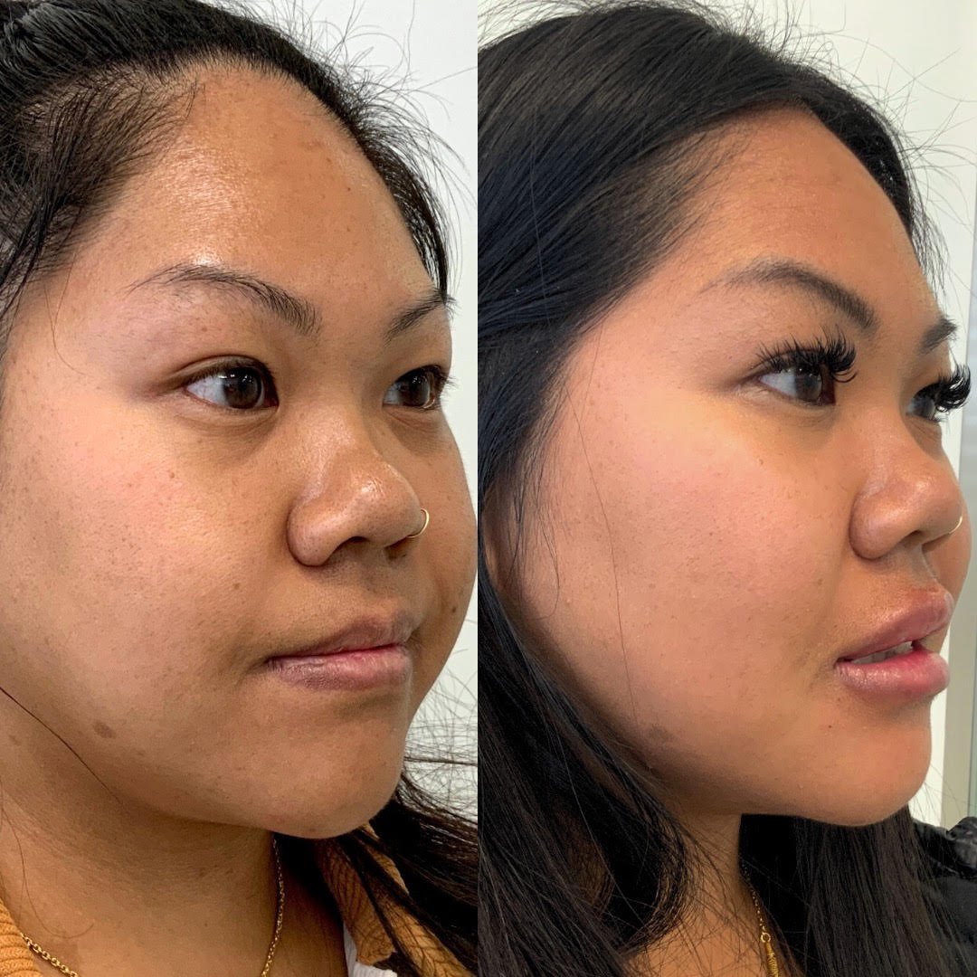Beautiful improvement in our model's cheeks lips and skin!