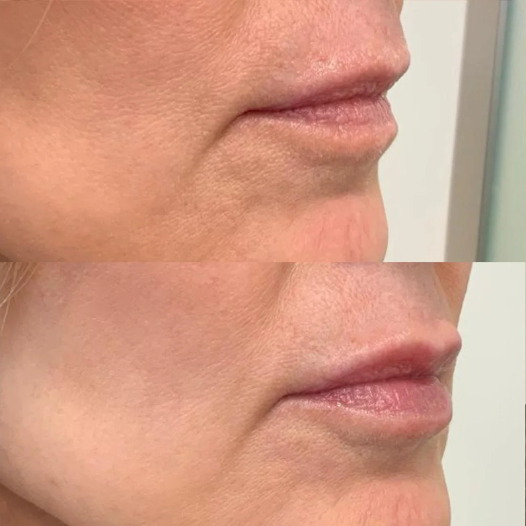 Fuller lips with little pain