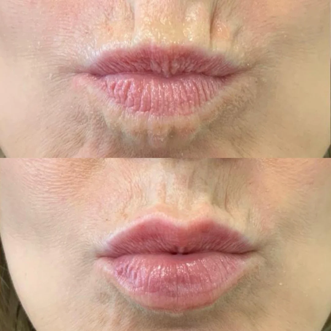 Fuller lips with little pain