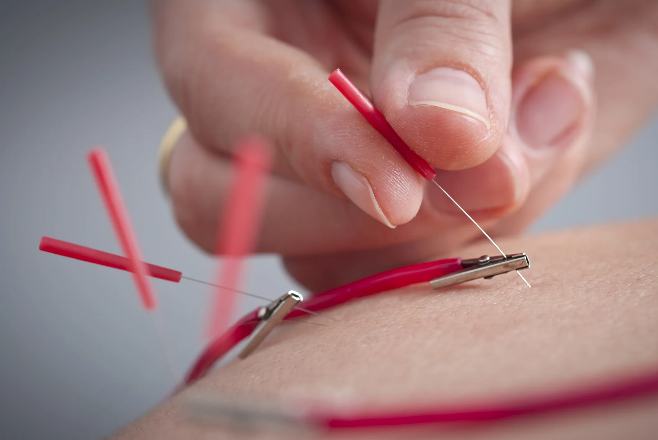 Electro-Acupuncture used to treat sport or orthopedic  injuries