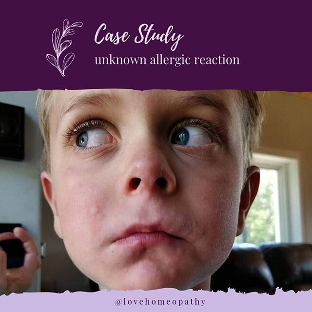 💜The power of homeopathy💜
My son had an allergic reaction to something...we are unsure what..but his lip, entire left side of his mouth, nose and cheek were rapidly swelling. 2 doses of Apis 30C 10 mins apart and voila. I have my boy back.
💜
Apis 