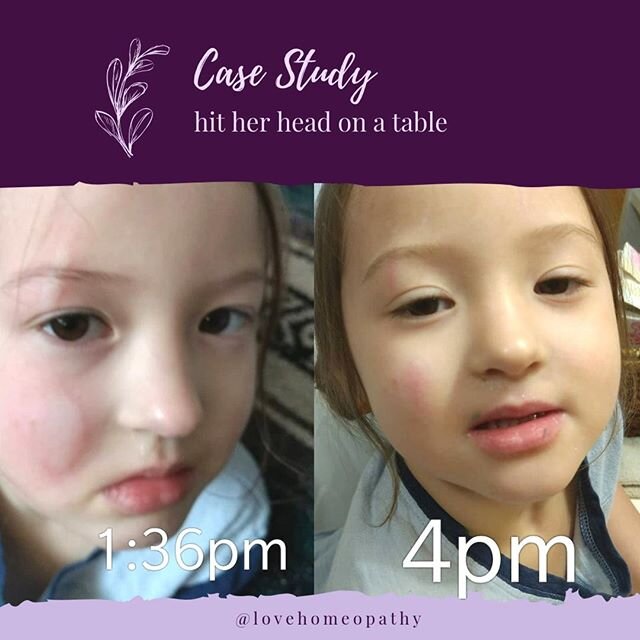 This little cutie fell while dancing and hit her head off a table.🤕
1 dose of Arnica 30C and you can see the changes!
🤕
She likely won't even bruise with a couple more doses of Arnica over the next day.
.
.
.
#noblackeyes #arnica #bruising #swellin