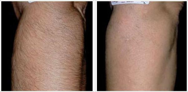 before and after arm.jpeg