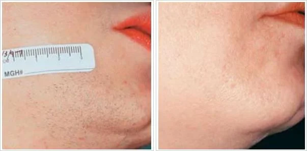 before and after chin female.jpeg