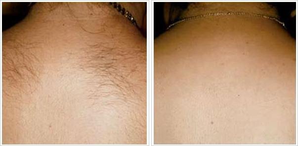 before and after upper back.jpeg