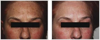 IPL-before-and-after (1).jpg