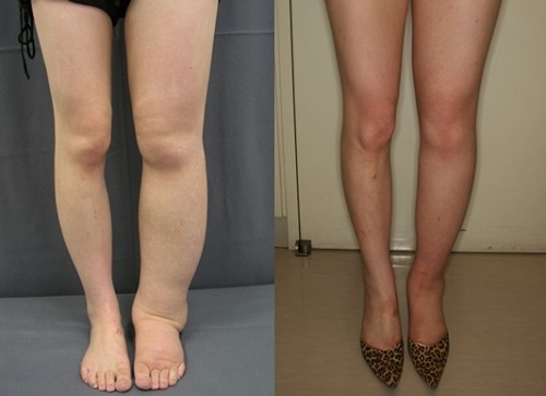 Lower Leg Lymphedema — ShechterCare