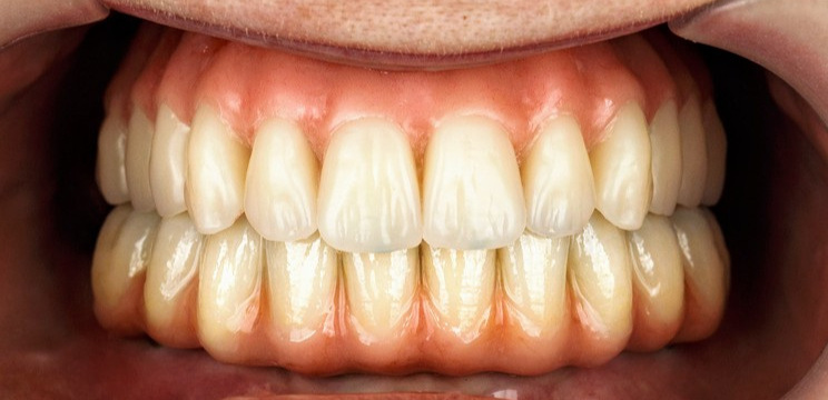 Why You Should Not Replace Teeth With Dental Implants