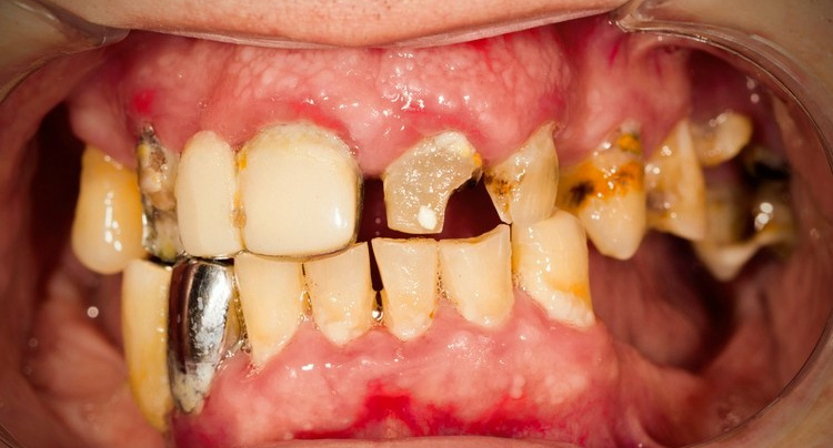 periodontal disease teeth before implants~5.jpg