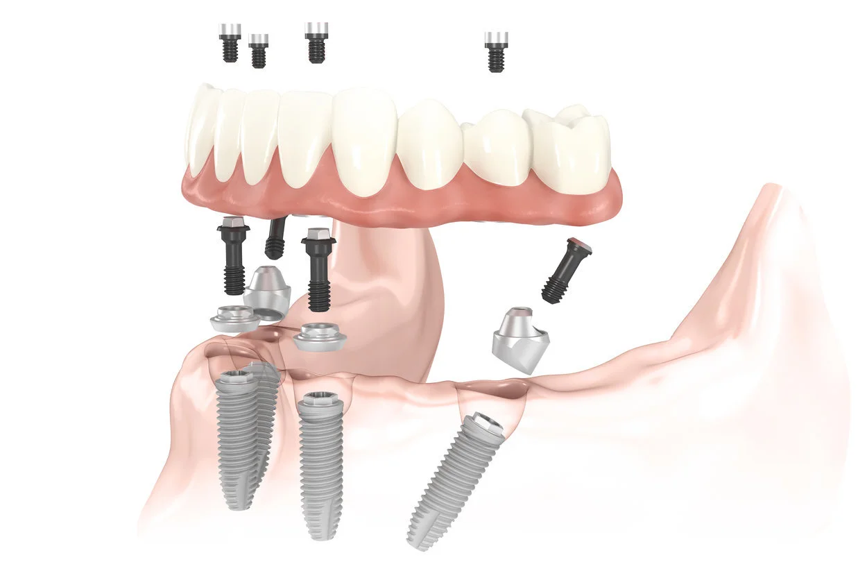 Dental Implants Google — Memphis Dentures and Implants