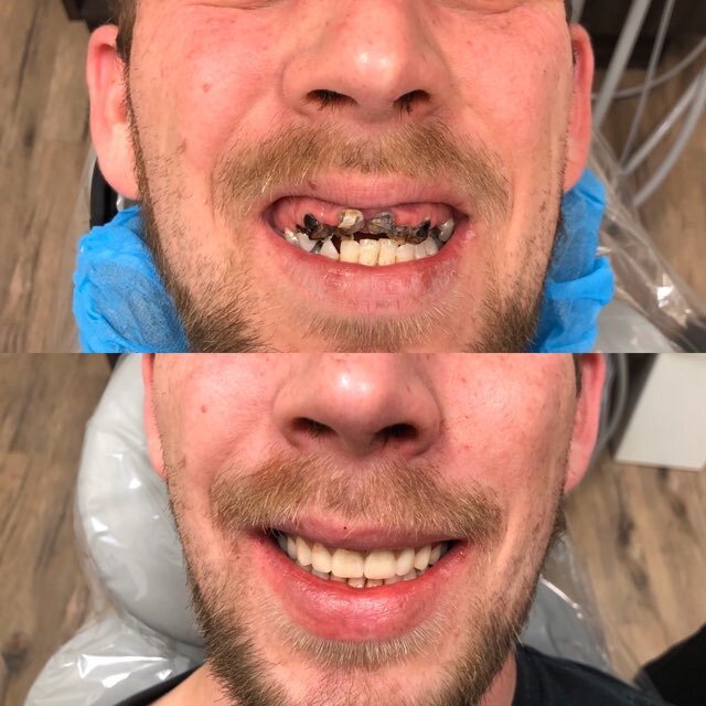 Immediate Dentures before And After Dentures  