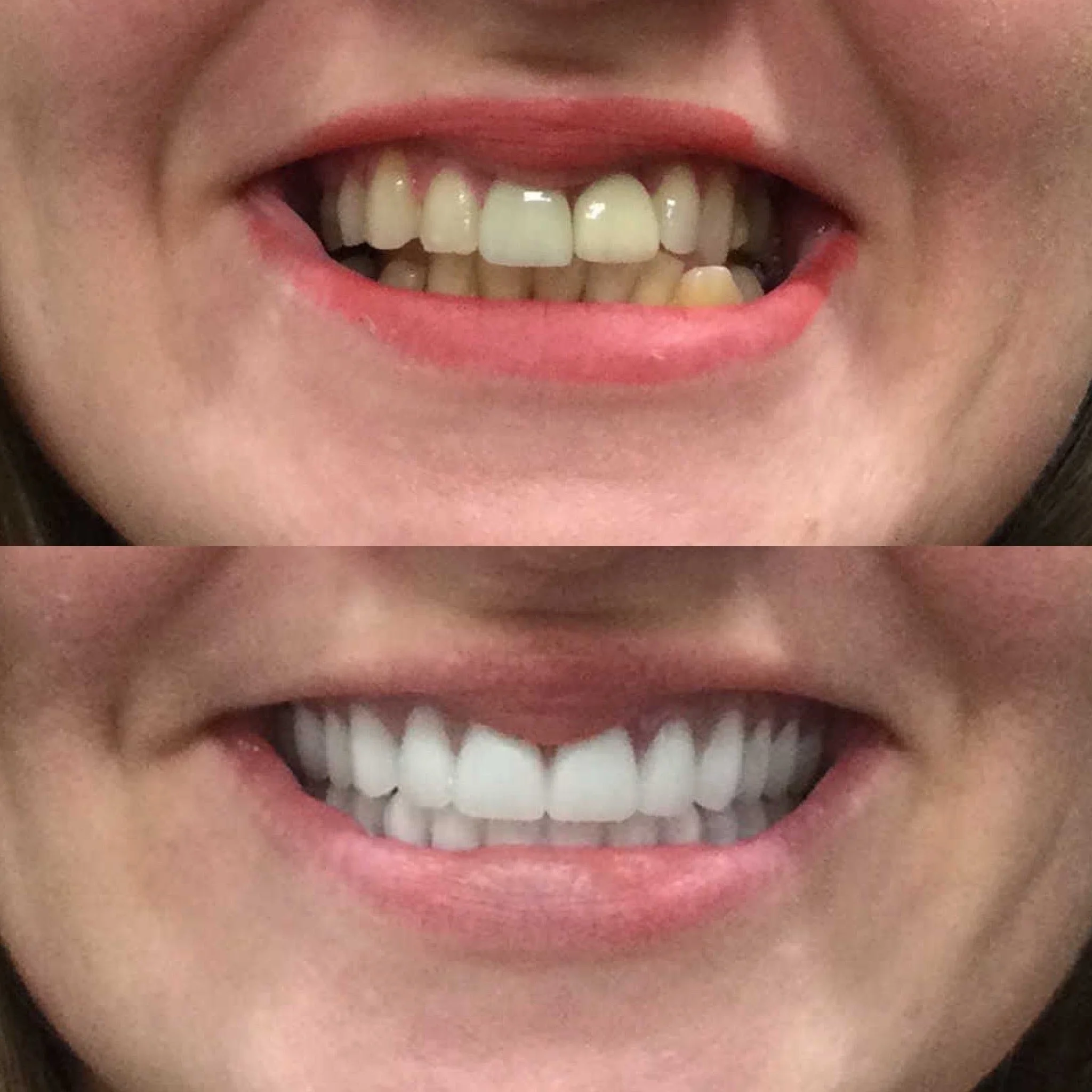 Snapin Implant Dentures — Memphis Dentures and Implants