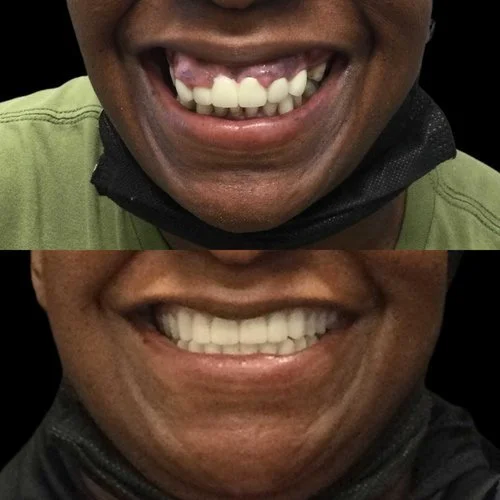 Dental Implants Bing — Memphis Dentures and Implants