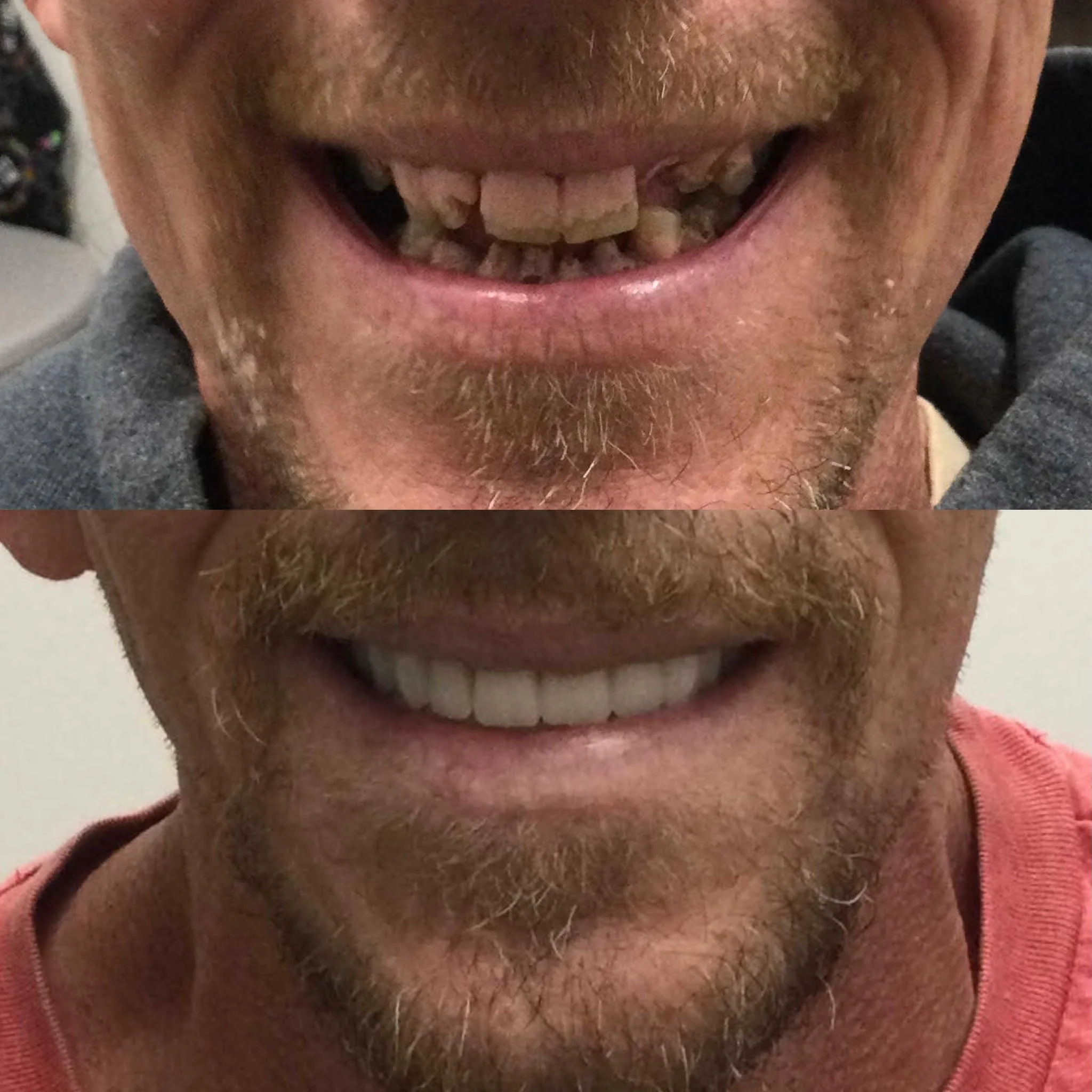 Dental Implants Bing — Memphis Dentures and Implants