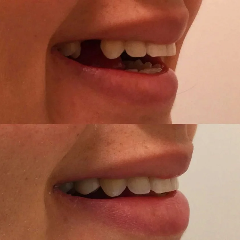 Dental Implants Bing — Memphis Dentures and Implants