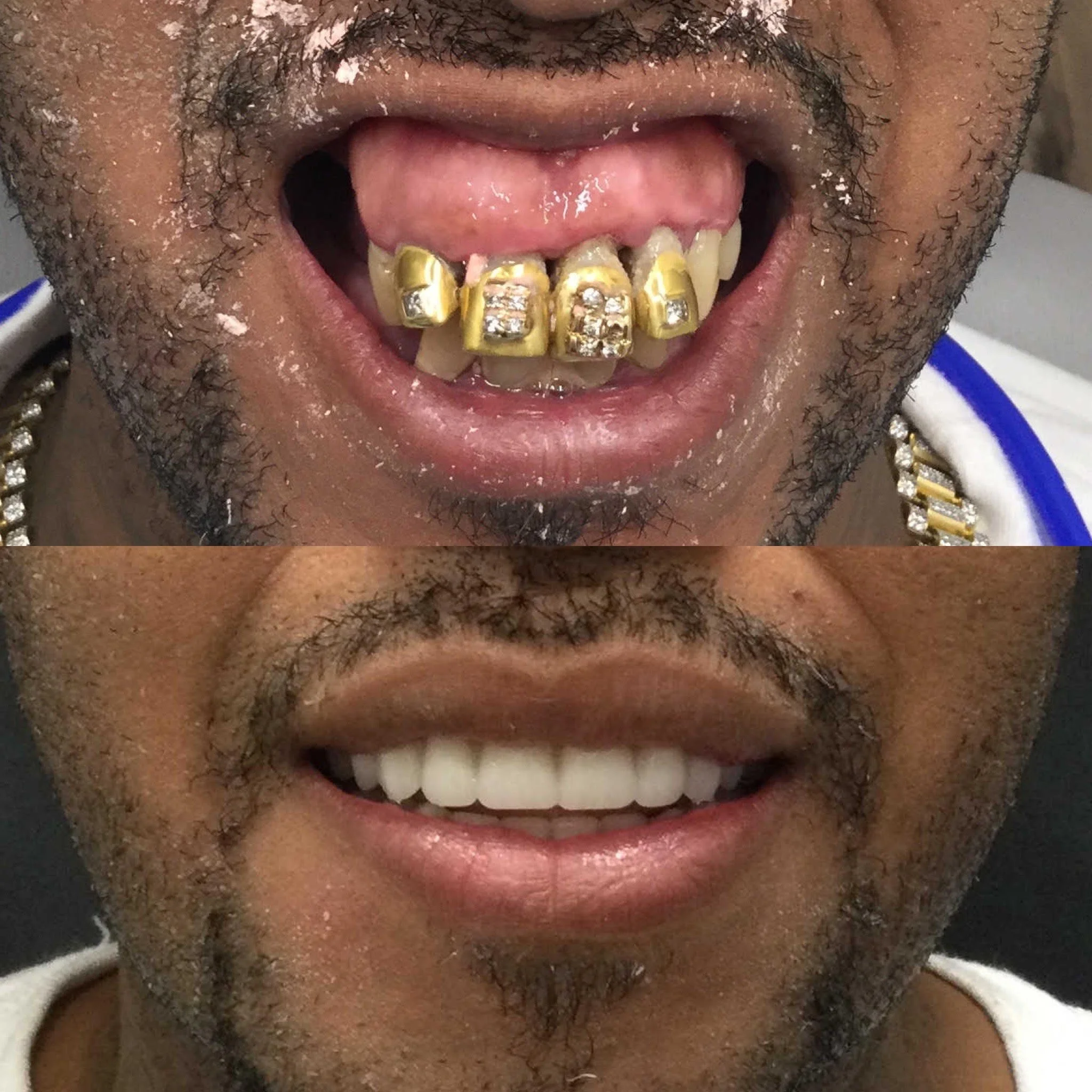 Cost of Dental Implants — Memphis Dentures and Implants