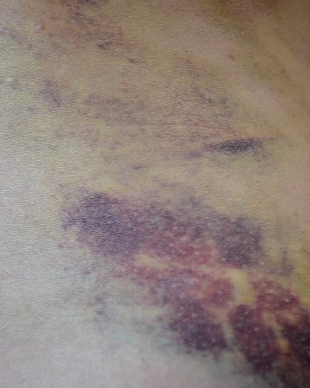 I wanted to share with you some of my old work. This is serial called &ldquo;bobo&rdquo; which mean a wound in French. This is a very personal story where I document some of the little wound I got in order to remember to take care of my body and to b