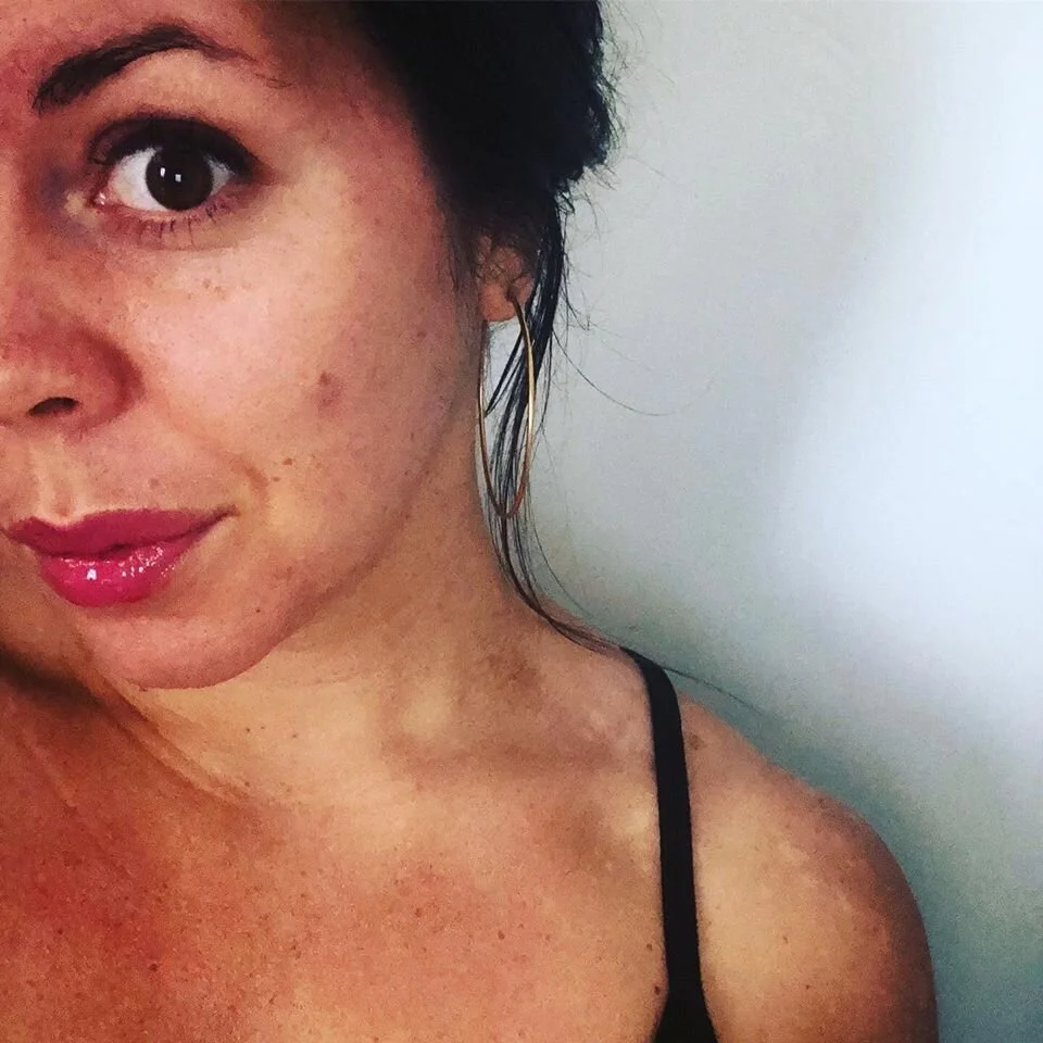 How to Heal Your Tinea Versicolor (Naturally) — Midday Pigeon Blog